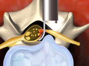 Endoscopic Spine Surgery