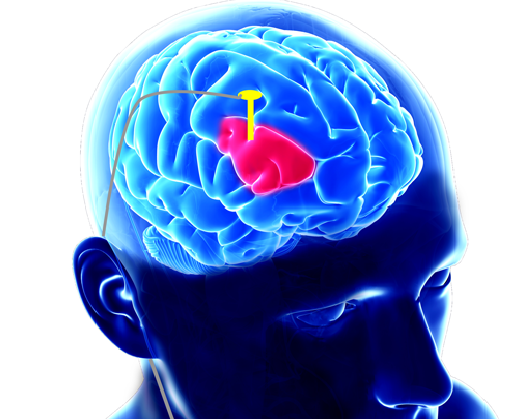 Deep Brain Stimulation