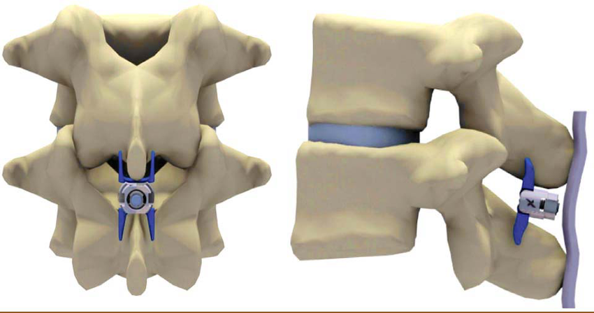 Cranio Vertebral Junction Anomalies